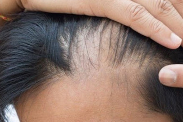 DHI SAÇ EKİMİNİN DEZAVANTAJLARI 