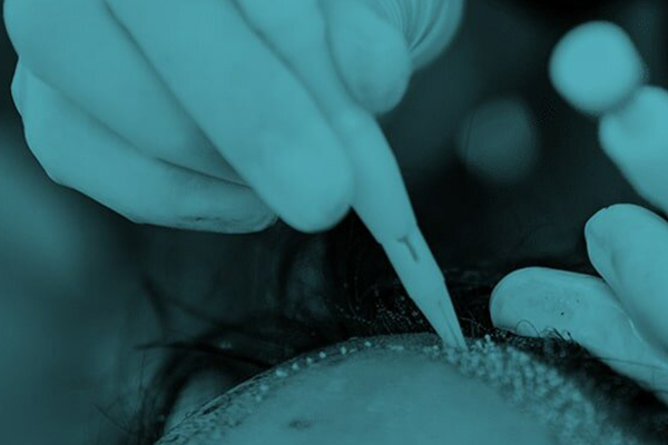 Sac-Ekimi-Temel-Asamalari-Nedir-