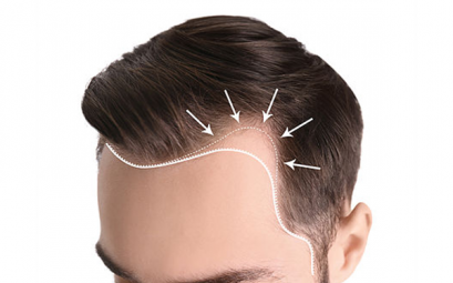 TIRASSIZ-SAC-EKIMI-NEDIR-