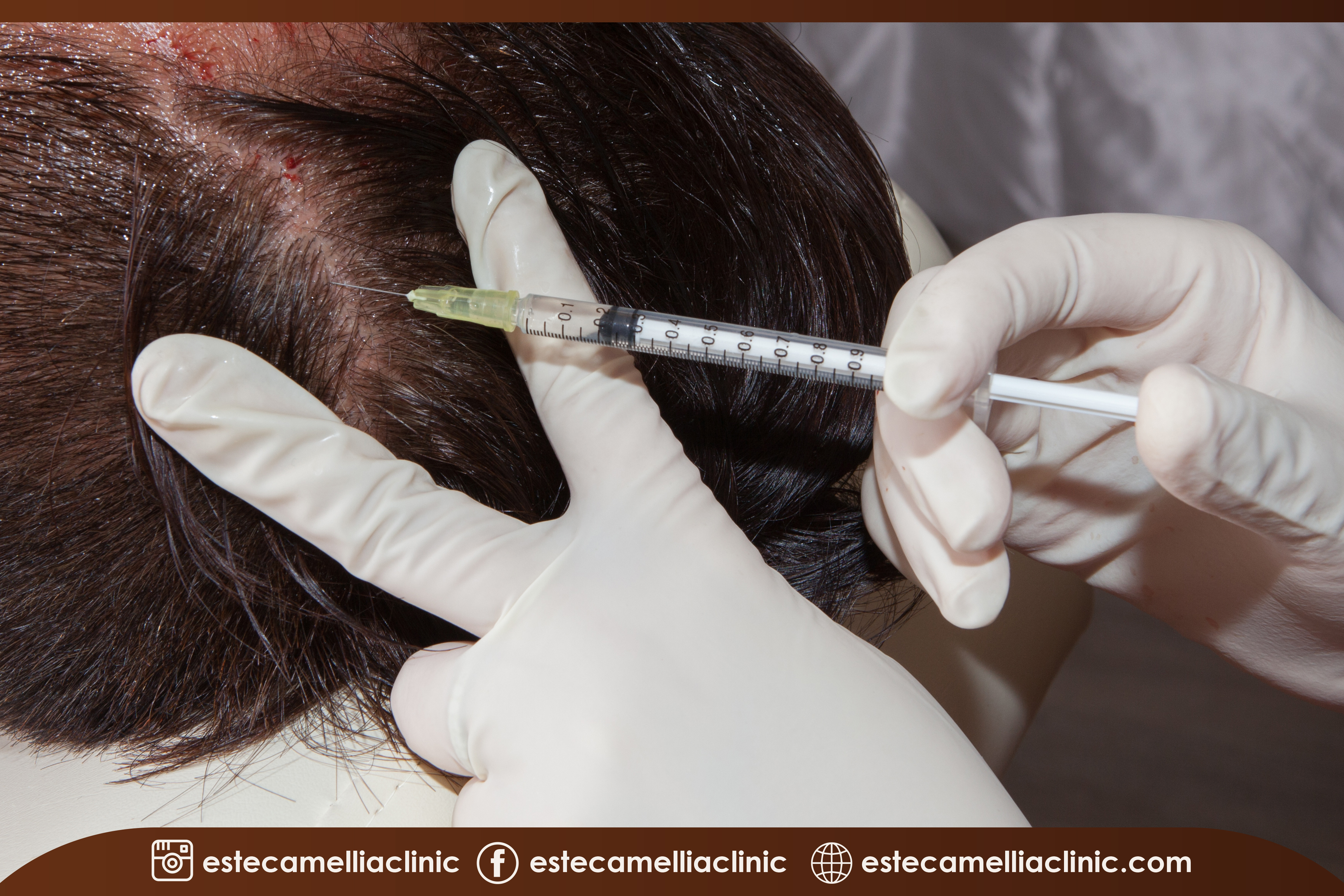 Saç Mezoterapisi Tedavisi